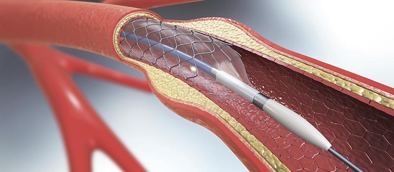 cardiac stent