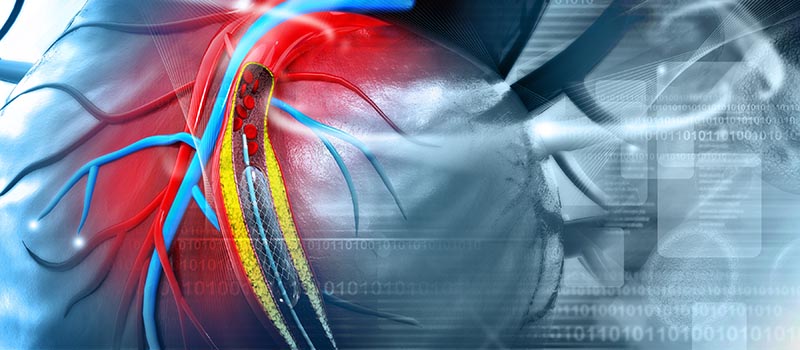cardiac stent