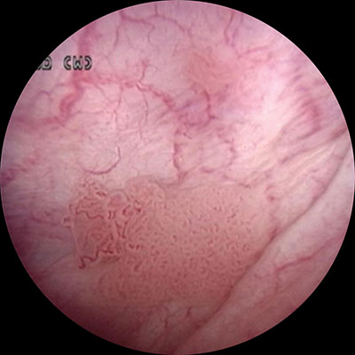 white light cytoscopy